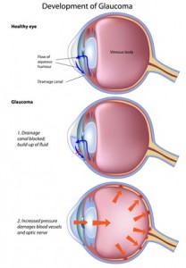 Stages of glaucoma in dogs